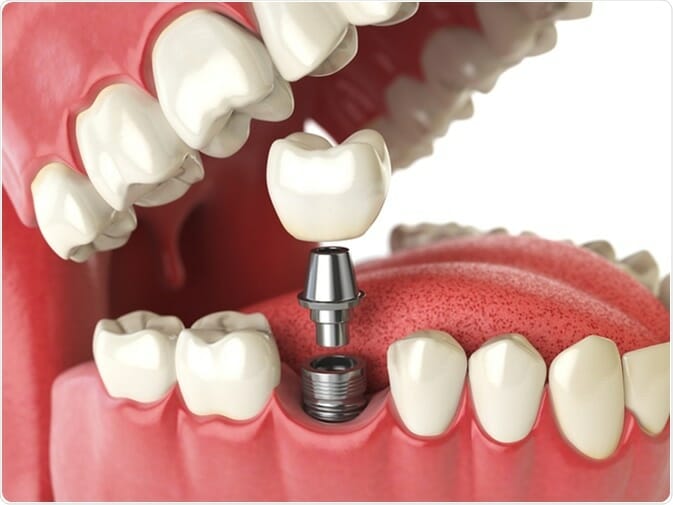 illustration of how dental implants in highland village, tx work and look