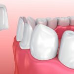 veneers data-lazy-srcset=