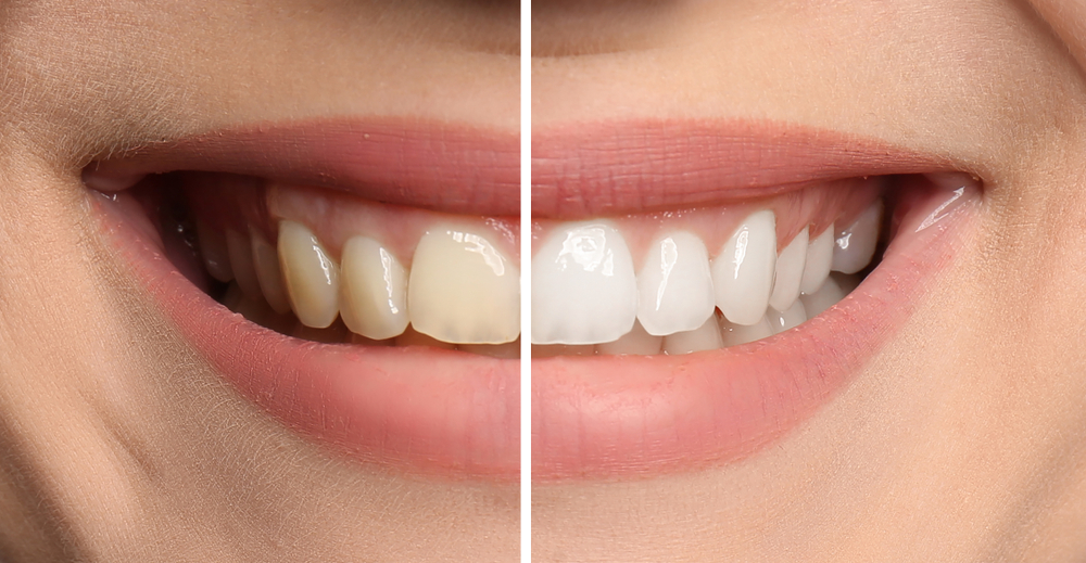 before and after Teeth whitening in Highland Village, TX